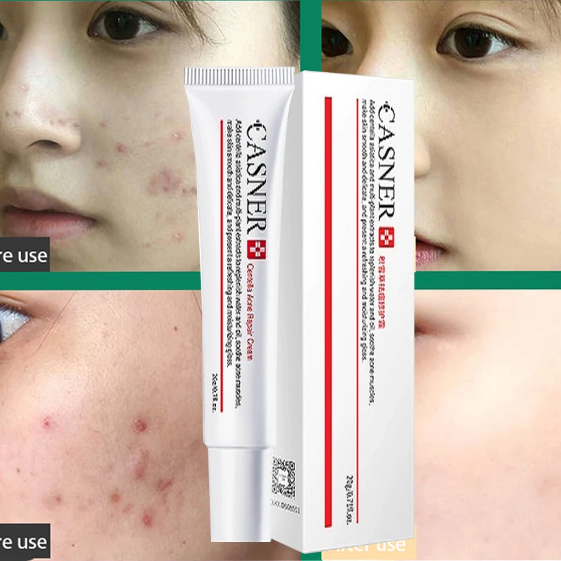 

Herbal anti-acne acne treatment ointment to remove acne, soothing and repairing moisturizing and oil control facial skin care