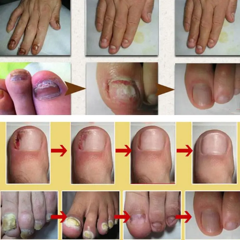 Противогрибковая эссенция из трав для лечения грибка ногтей | Красота и здоровье