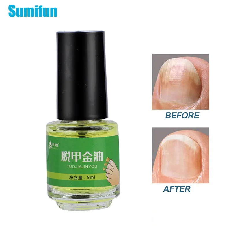 

5ml Nail Fungal Treatment Antibacterial Oil Onychomycosis Removal Solution Foot Toe Nail Fungus Infection Repair Essence Cream