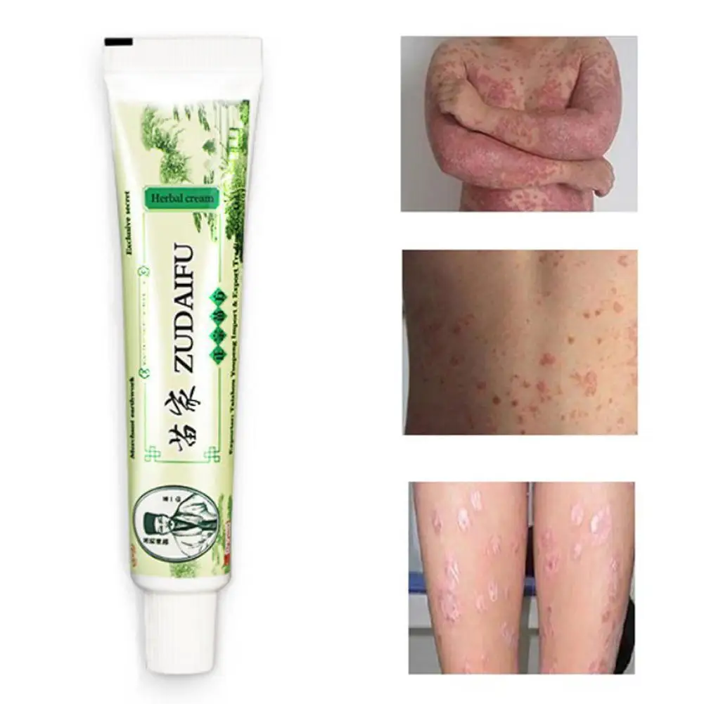 Высококачественный полезный крем для ухода за кожей псориаза кожи дерматит