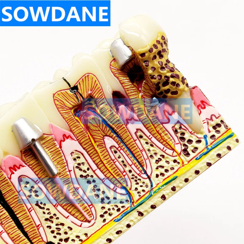 Зубные протезы модель обычной патологии обучающая зубной Стоматолог для изучения медицины