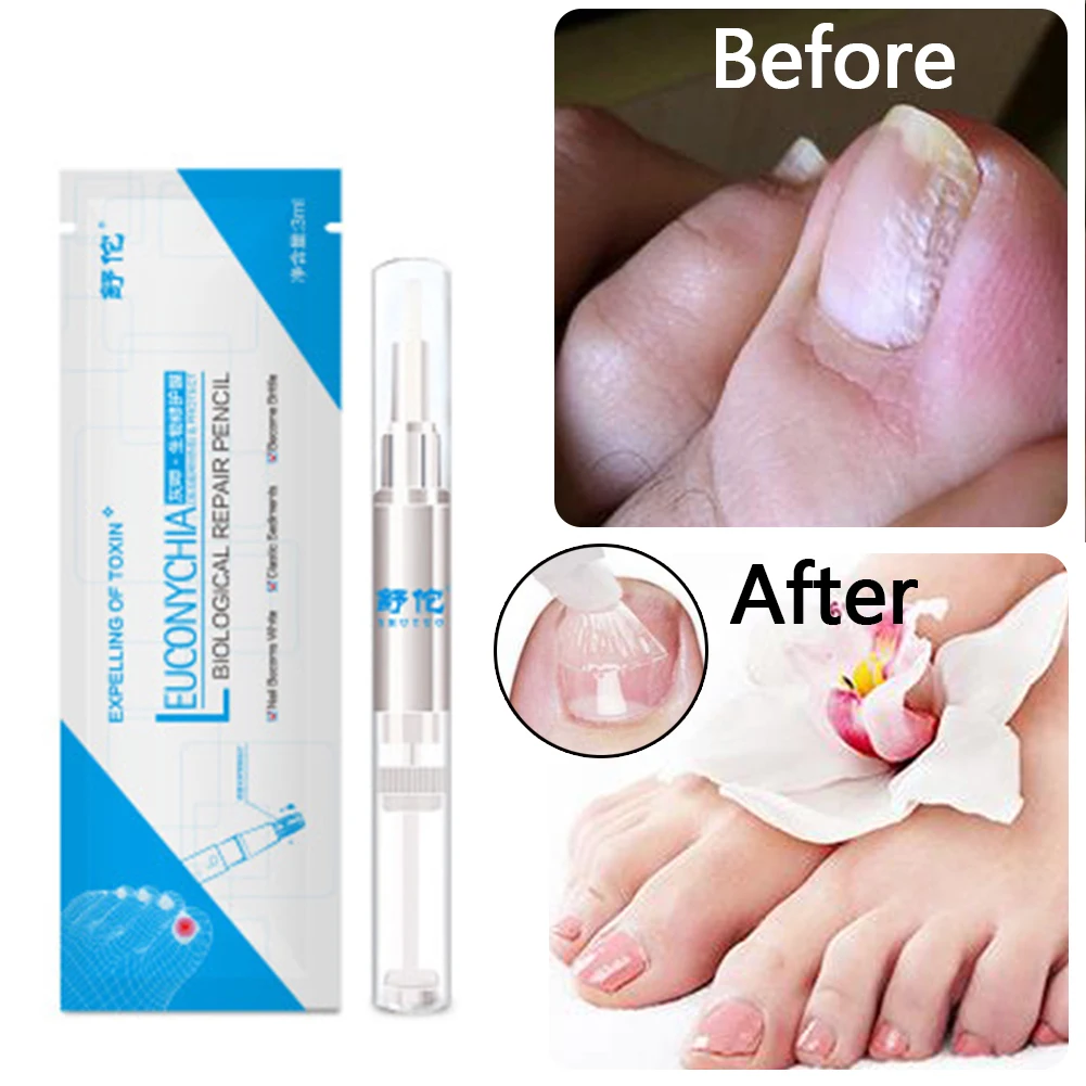 

3ML Anti Fungal Treatment Nail Pen Onychomycosis Paronychia Infection Herbal Toe Finger Nails Health Beauty Accessories