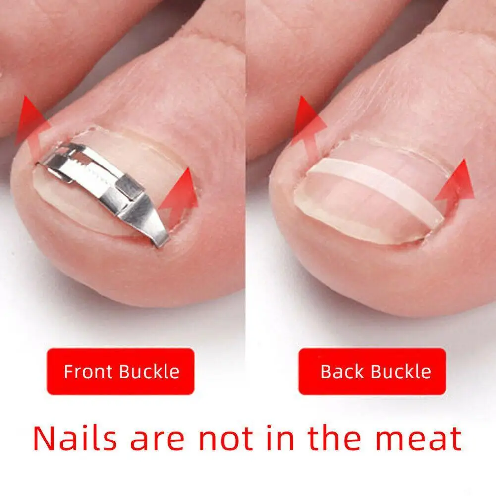 

1 Pair Of Ingrown Toe Nail Holders Embedded In Toe Nail Correction Lifter Foot Care Pedicure Repair