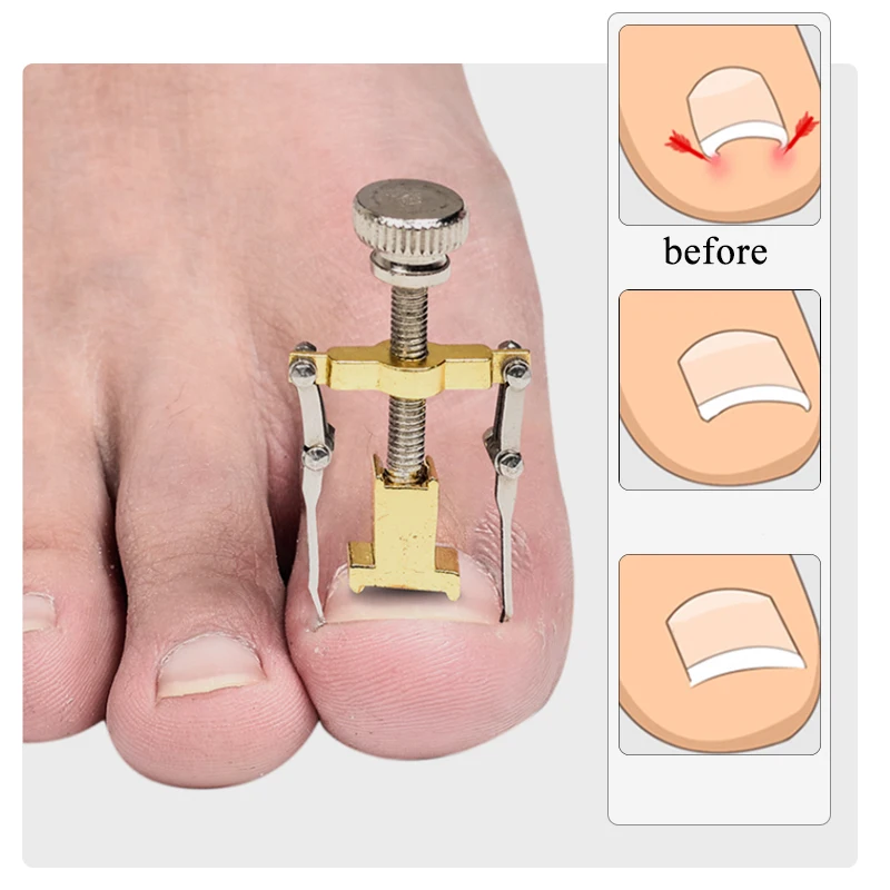 Средство для ухода за вросшими ногтями корректор ногтей профессиональное