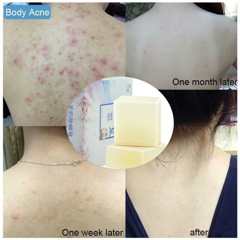 Мыло с морской солью очищение молока Удаление прыщей удаление акне контроль
