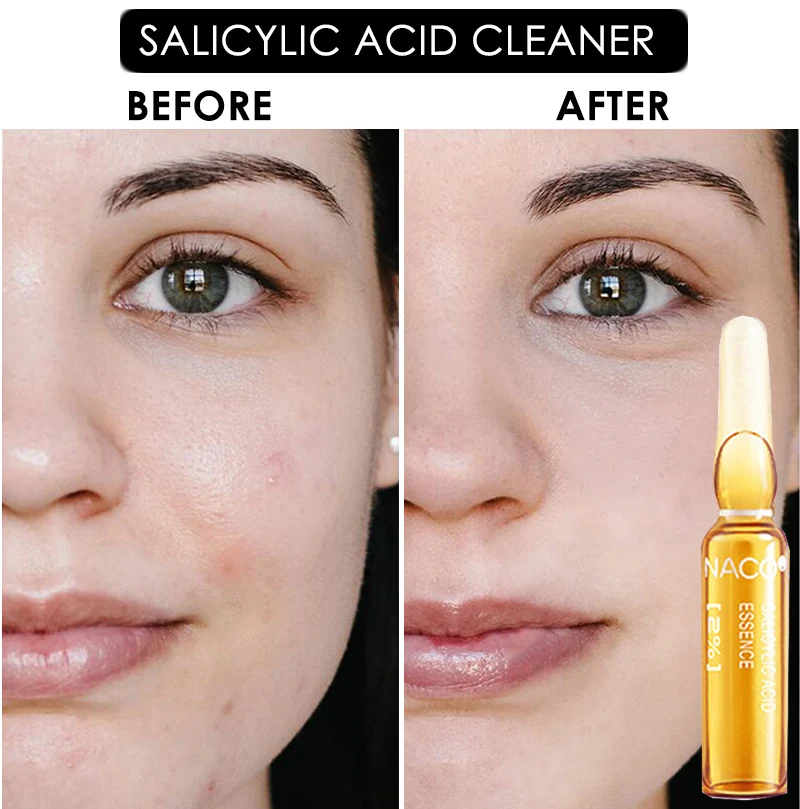 Отбеливающая отбеливающая Сыворотка для лица 2% раствора салициловой кислоты