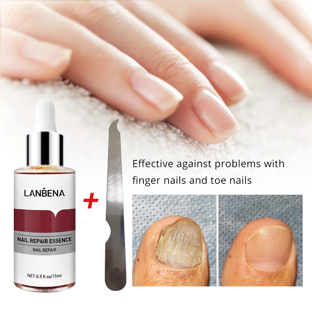 LANBENA Fungal Nail Treatment Feet Care Essence Removal Fungus Healthy Repair Serum Anti Infection Paronychia Onychomycosis