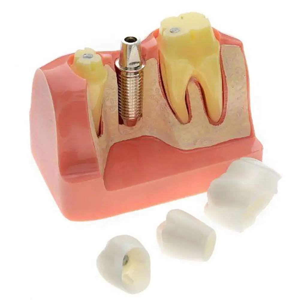 Профессиональная Стоматологическая модель зубов прозрачная патологическая