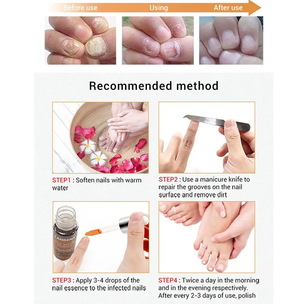 Лечение ногтей от грибка Уход за ногами и ногтями ремонт эссенция