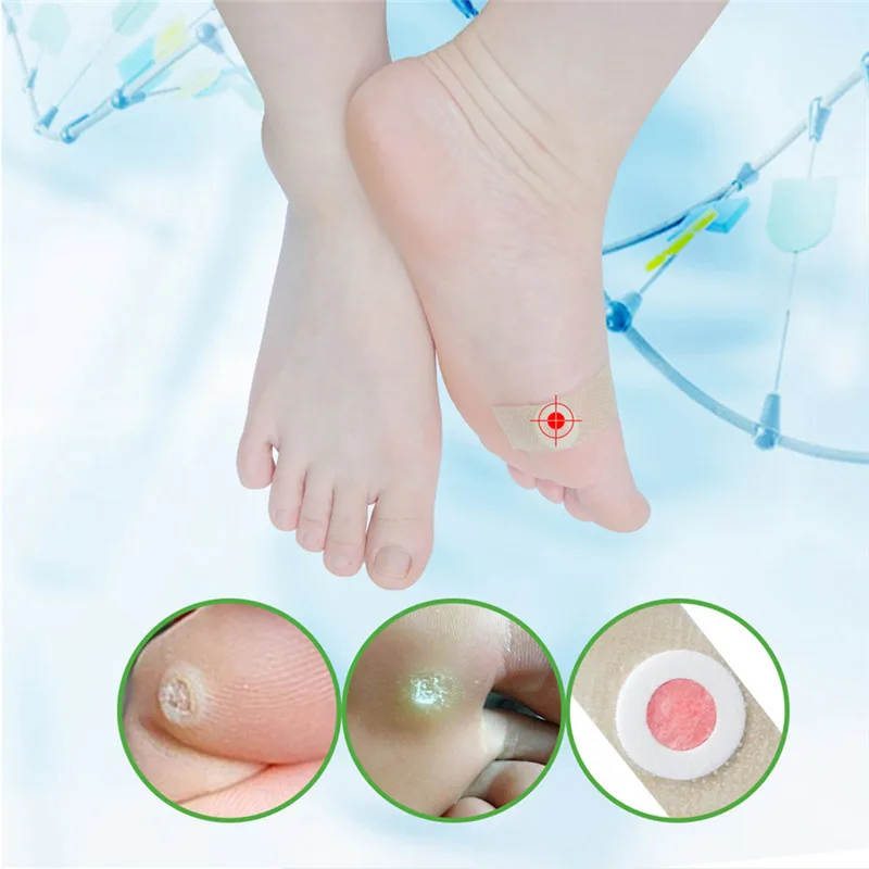 Sumifun 42 шт./лот удаление мозолей паста старый кокон шип для ног кукурузная