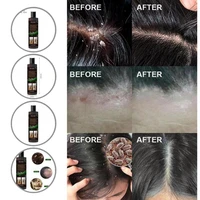 anti dandruff shampoo delicate texture no additives non irritating hair dandruff removal shampoo