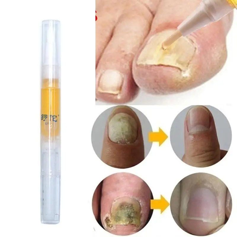 

Anti-Fungal Home Treatment Set Toe Nail Treatment Pen Fungus Care Paronychia Kit Anti Repair Onychomycosis Serum Fungus M1G0