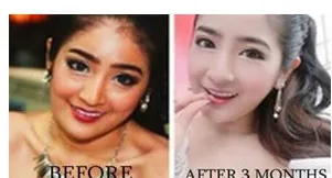 

1 bottle / 2 bottles-Gluta 1,500,000 mg ultra strong whitening glutathione white anti aging 1 bottle=30p