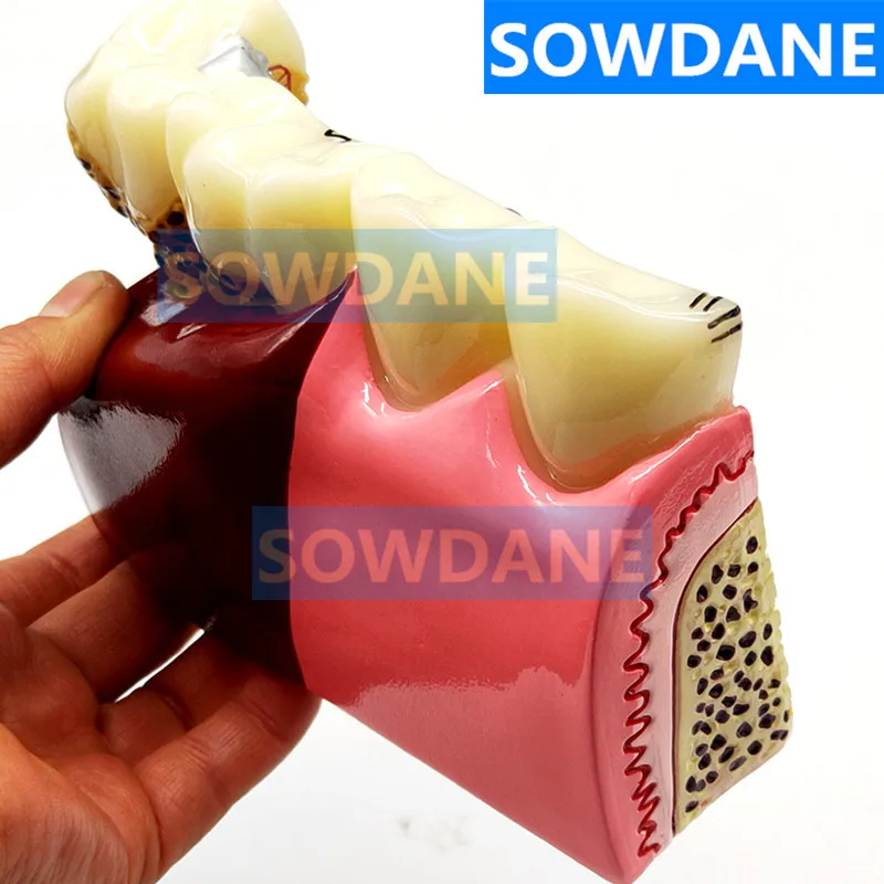 Зубные протезы модель обычной патологии обучающая зубной Стоматолог для изучения медицины