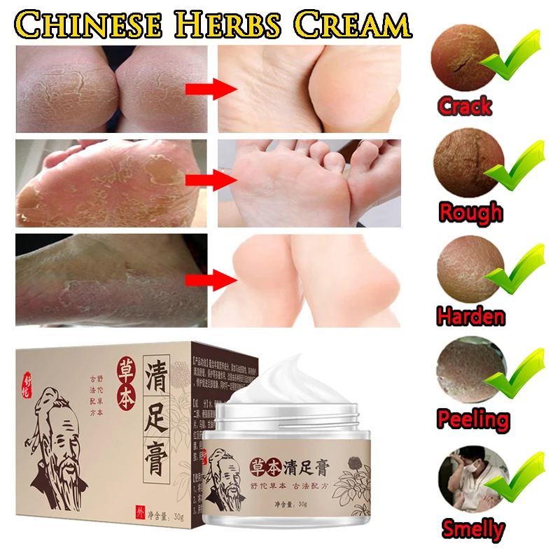 

Chinese Herbs Foot Crack Cream Exfoliating Feet Ringworm Peeling Bubbly Fast Relief Skin Itching Cure feet Smelly Repair Crack