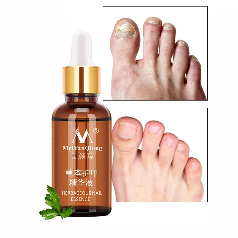 

Nail Fungal Treatment Feet Care Essence Nail Foot Whitening Toe Nail Fungus Removal Gel Anti Infection Paronychia Onychomycosis