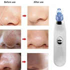 Аппарат вакуумный для удаления черных точек, носа, лица