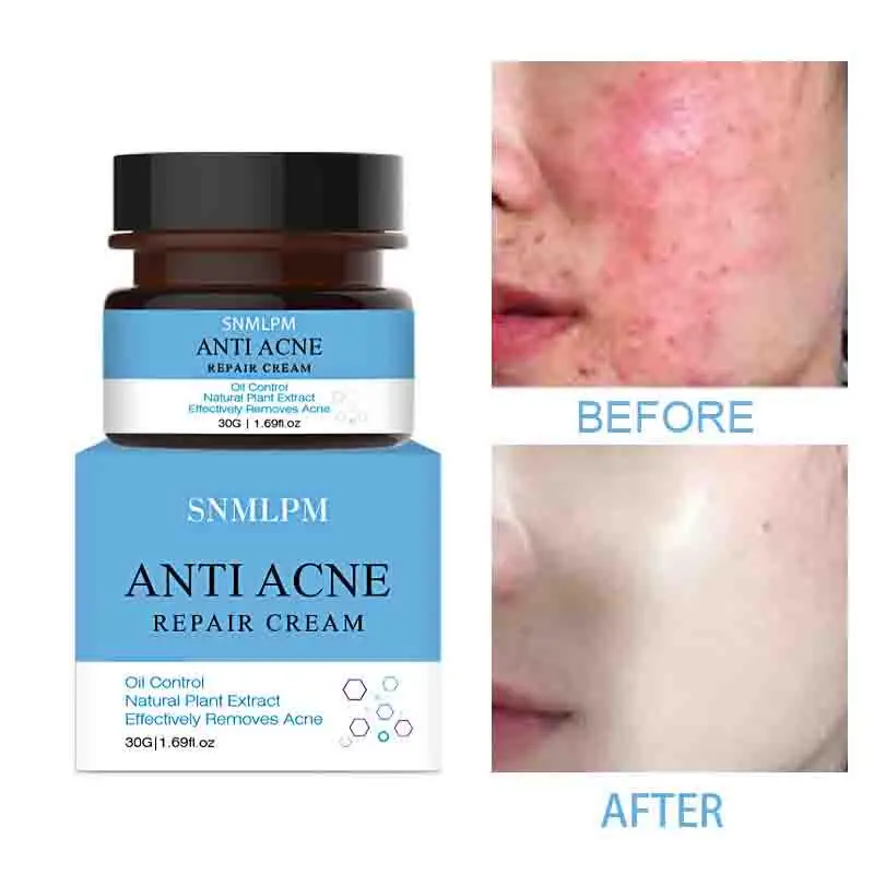 

Крем для удаления акне, эфирное масло чайного дерева, омолаживающий крем для удаления акне