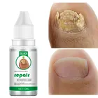 Лечение ногтей от грибков Уход за ногами Сыворотка для ногтей восстановление ногтей против инфекции паронихия онихомикоз удаление грибка ногтей гель Уход