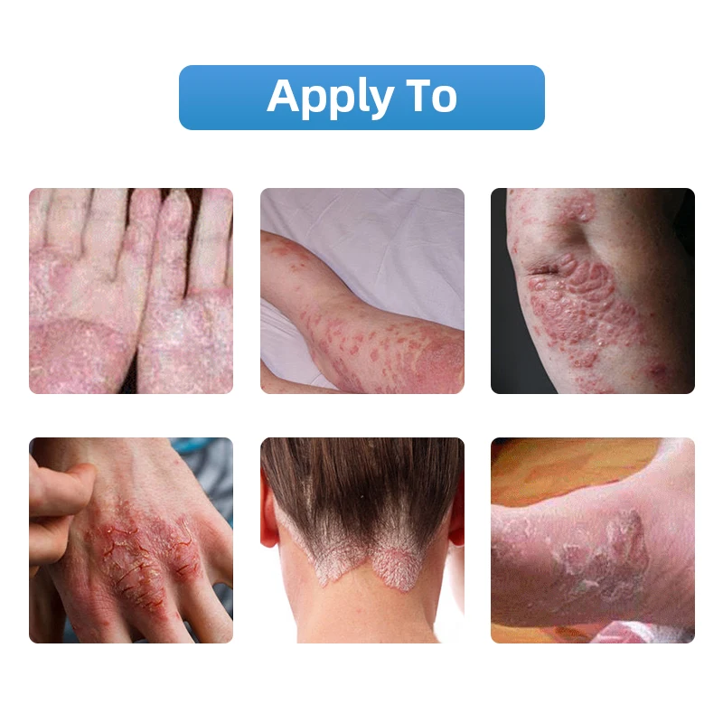 Натуральный травяной медицины псориаз мазь антибактериальные дерматит зуда для