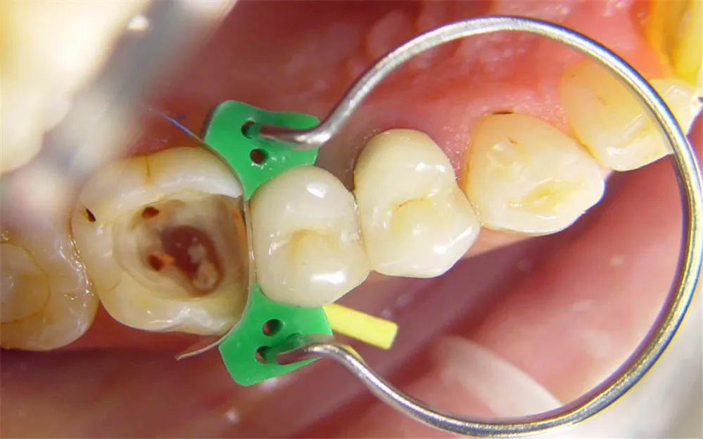 кольцо для матрицы стоматология. зажим для матрицы стоматология. кольца гаррисон для стоматологии. матричные системы в стоматологии. система палодент кольца.