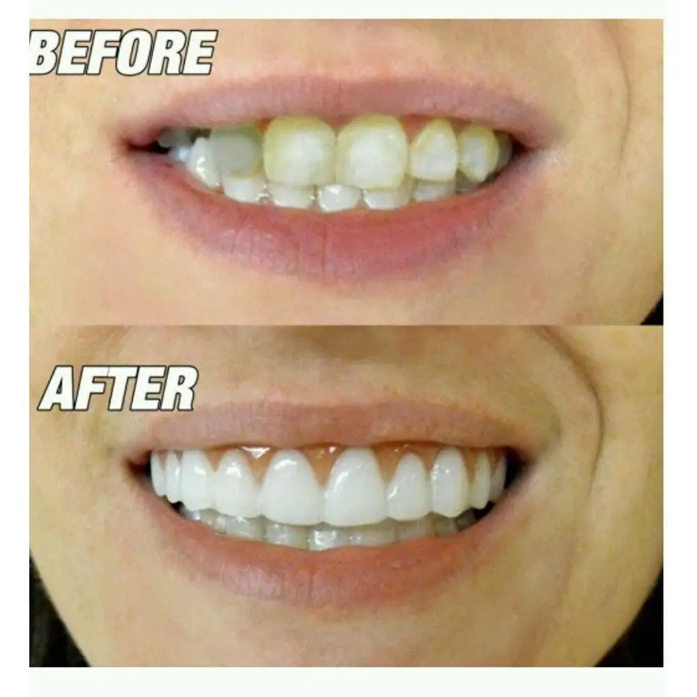 1 Set Smile Denture Cosmetic Teeth Comfortable Veneer Cover Whitening Snap On | Красота и здоровье