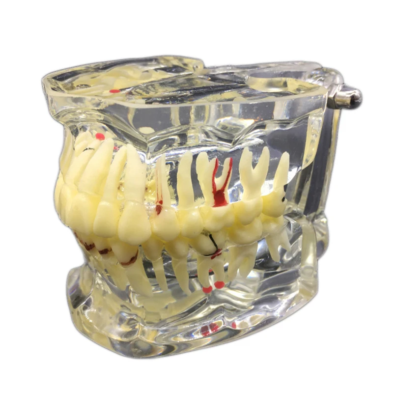 

Dental Transparent Adult Pathological Teeth Display Model Disease Teeth Model Dental Lab Equipment Dentist Teaching Model