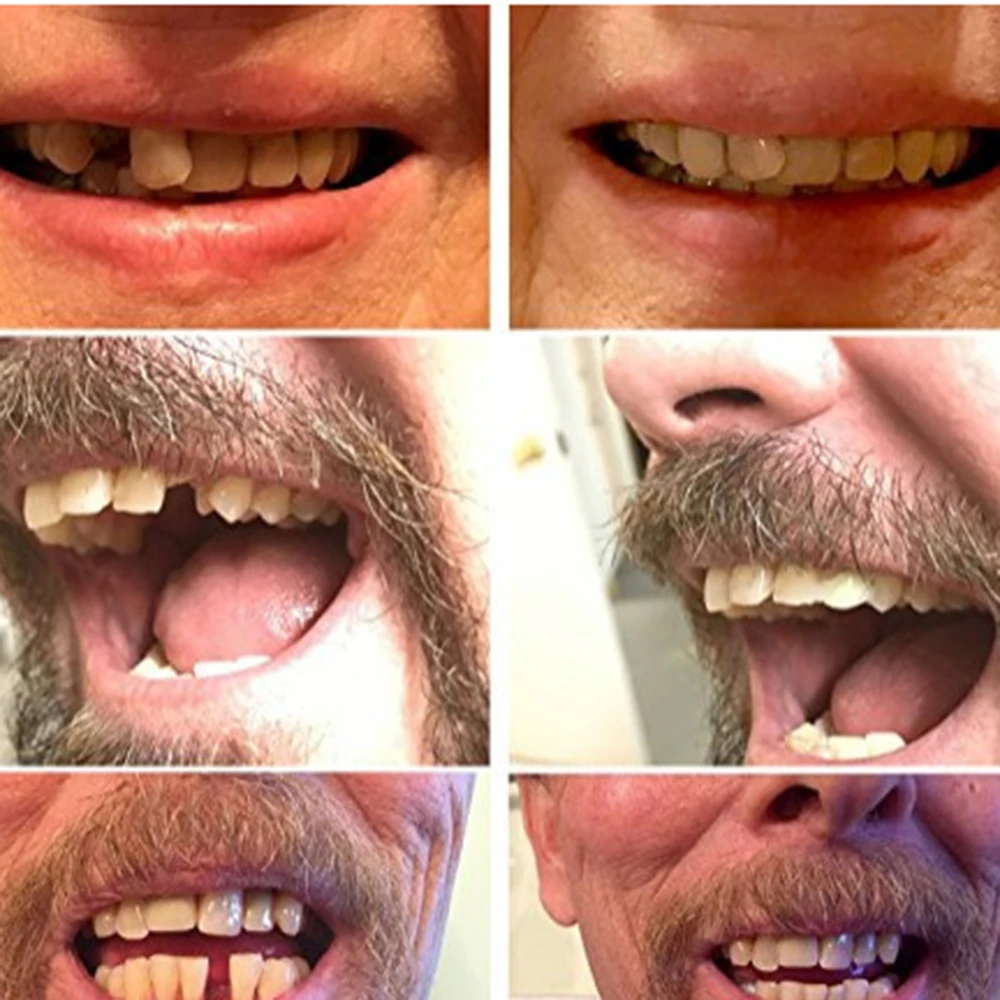 Силиконовые фигурные брекеты отбеливающая зубная паста зубные протезы Красота