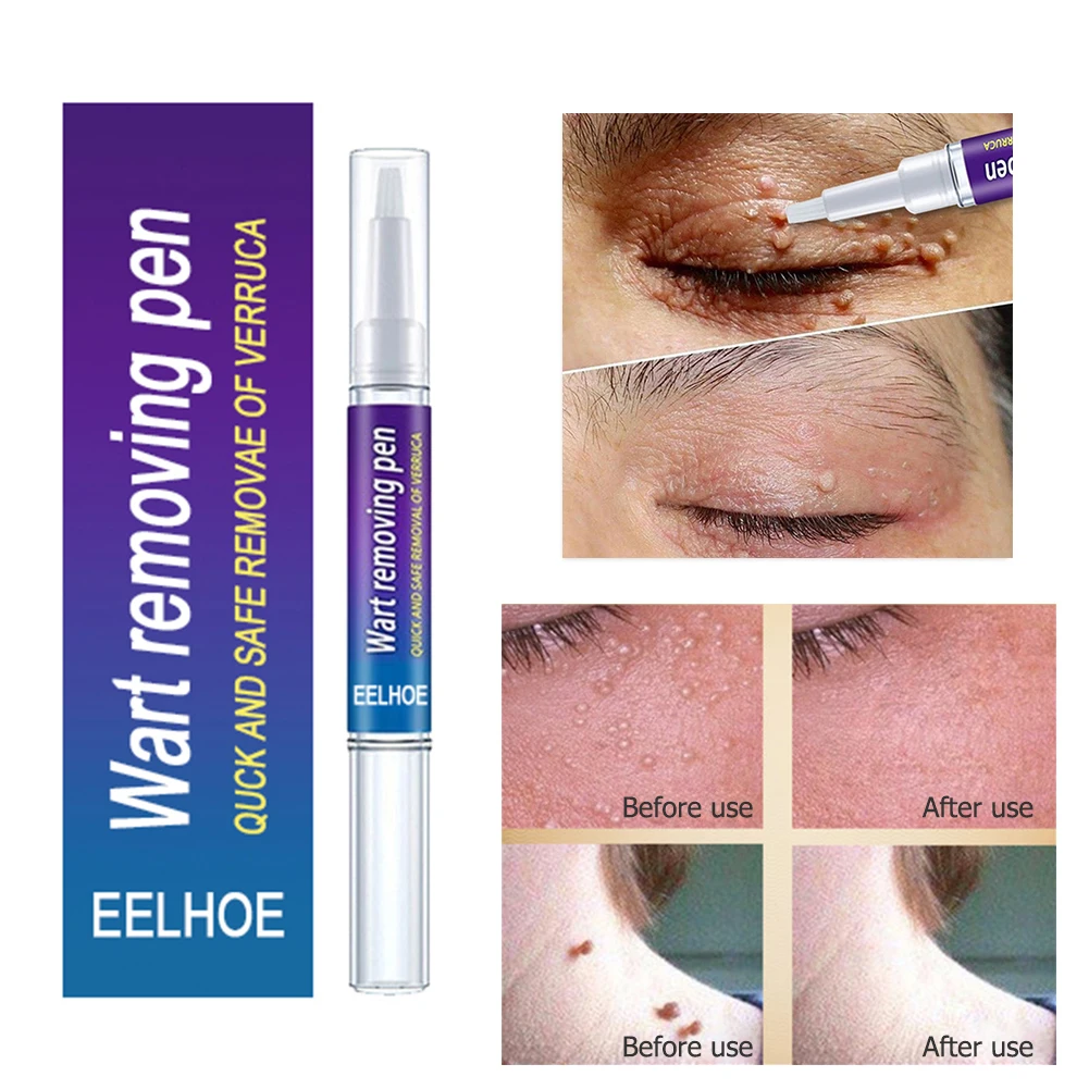 

Wart Removal Body Treatment Cream Skin Tag Remover Herbal Medicine Plaster