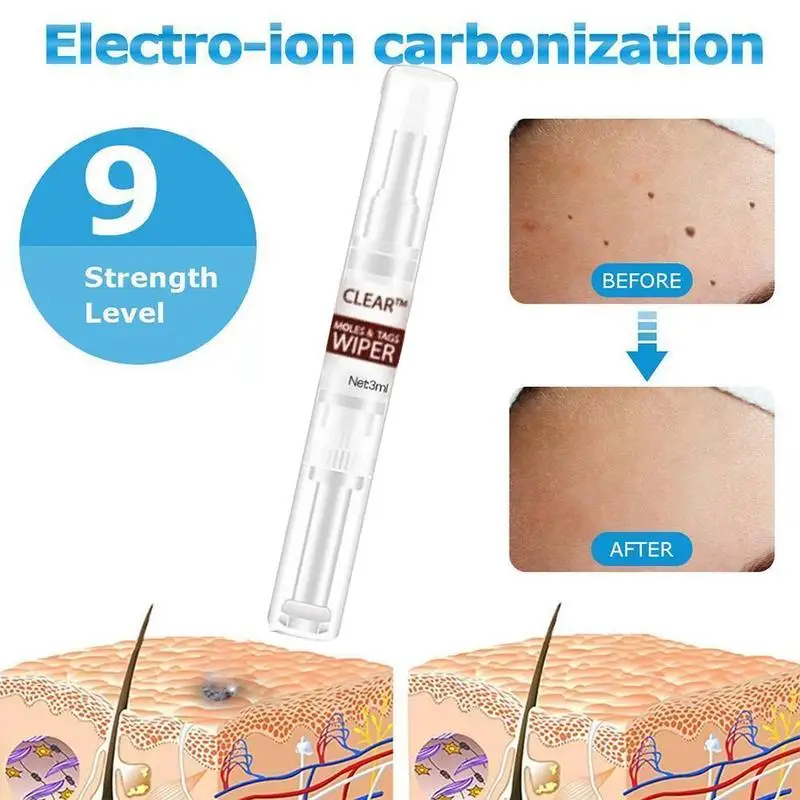 

Tags & Moles Remover Liquid Wart Removal Pen Genital Wart Treatment 3ml