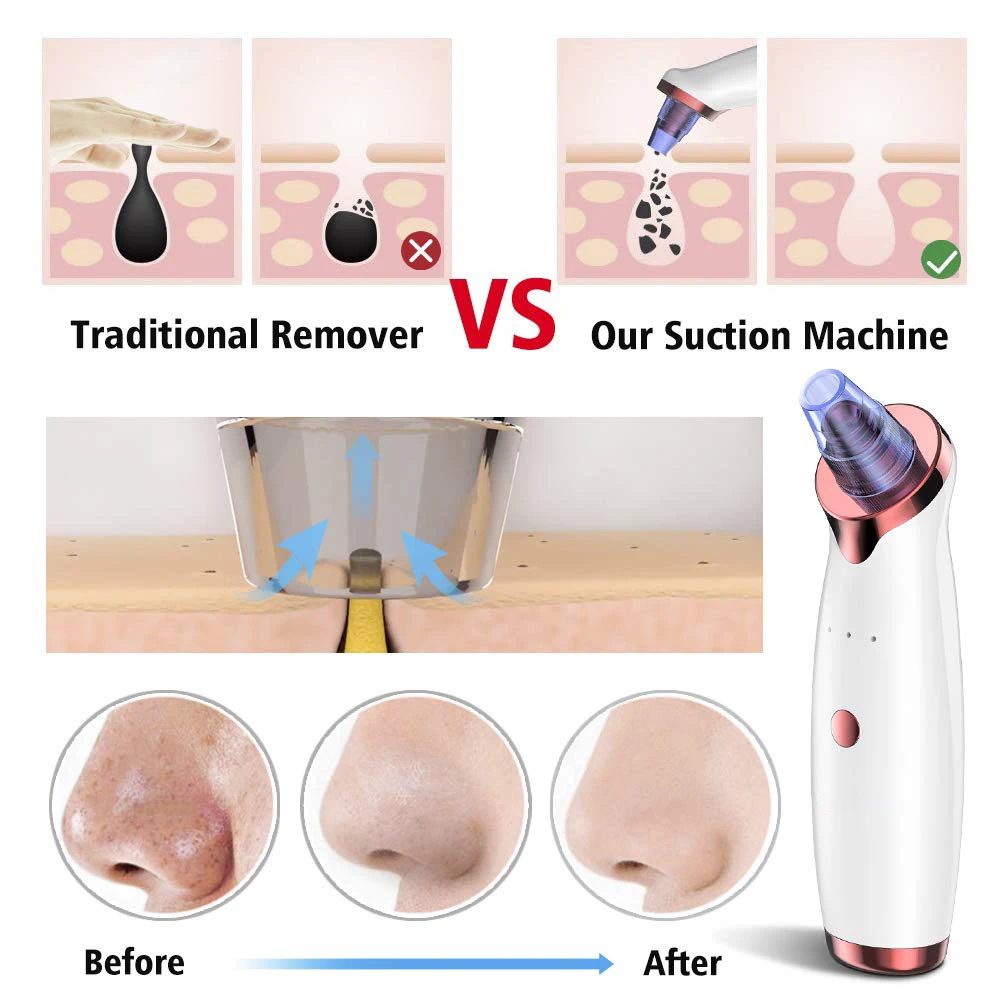 Средство для удаления угрей 4 шт. иглы прыщей глубокое очищение пор лица комедона