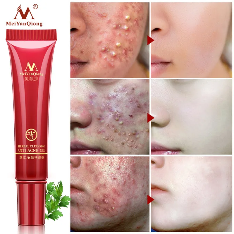 MerYanQiong Acne Treatment Gel Remove Pimples Face Scars Cream Anti Removal Shrink Pores Whitening | Красота и здоровье