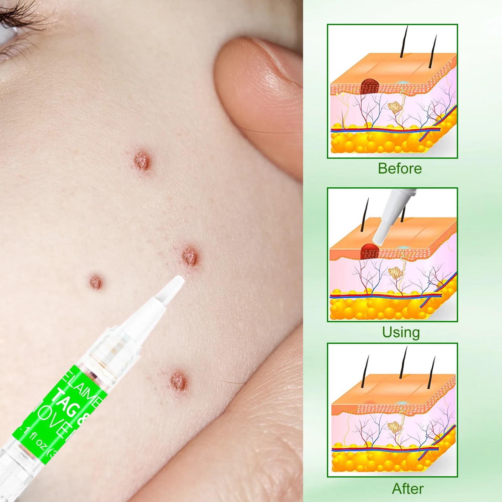 2 шт. средство для удаления бородавок и | Красота здоровье