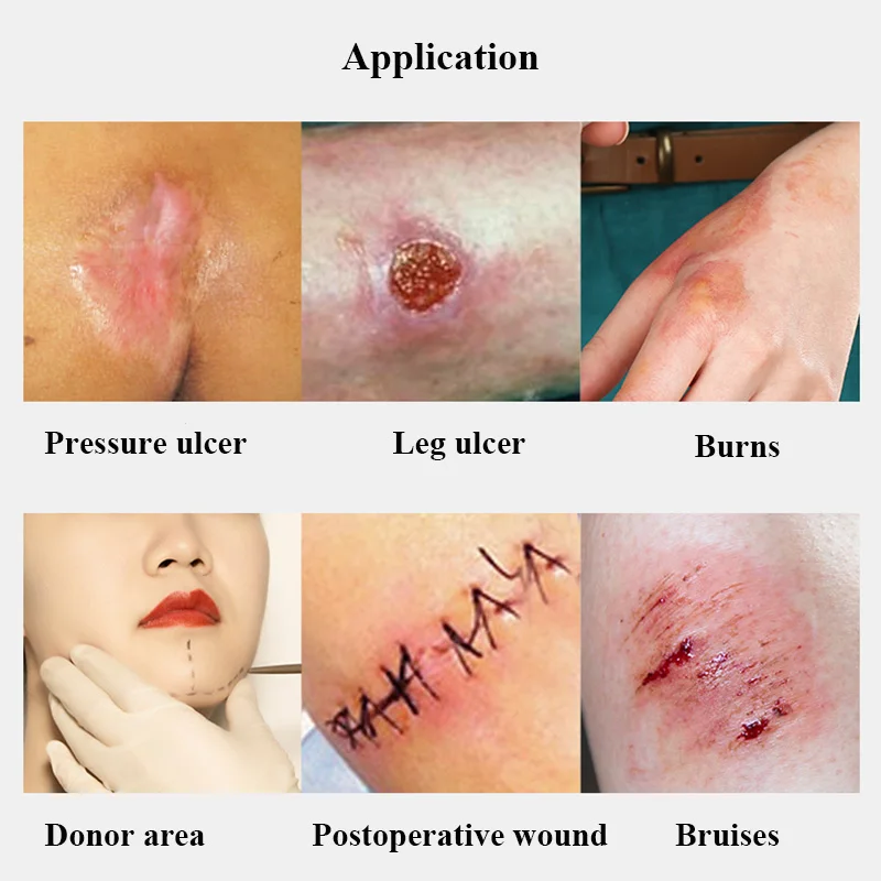 10Pcs Non-Stick Ag Silver Calcium Alginate Wound Dressing Surgery Burn Ulcer Healing Patch High Absorbent 10cmx10cm |