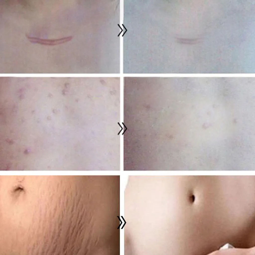 Гель для удаления шрамов от келоидов ожогов спортивных травм акне 30 г