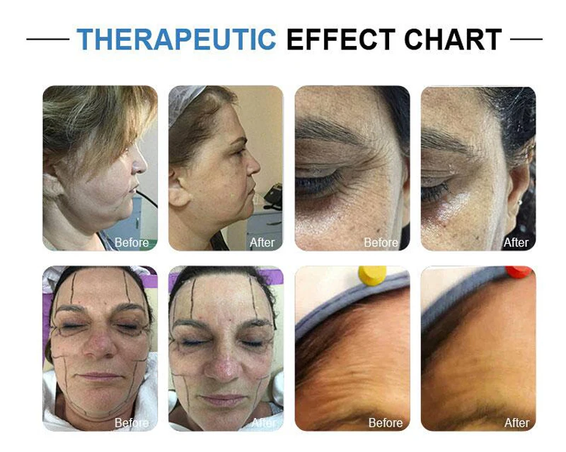 Ультразвуковой косметический аппарат 3D 4D против морщин лифтинг лица подтяжка