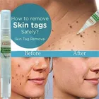 Средство для удаления родинок и бородавок на ногах, 12 часов, 3 мл