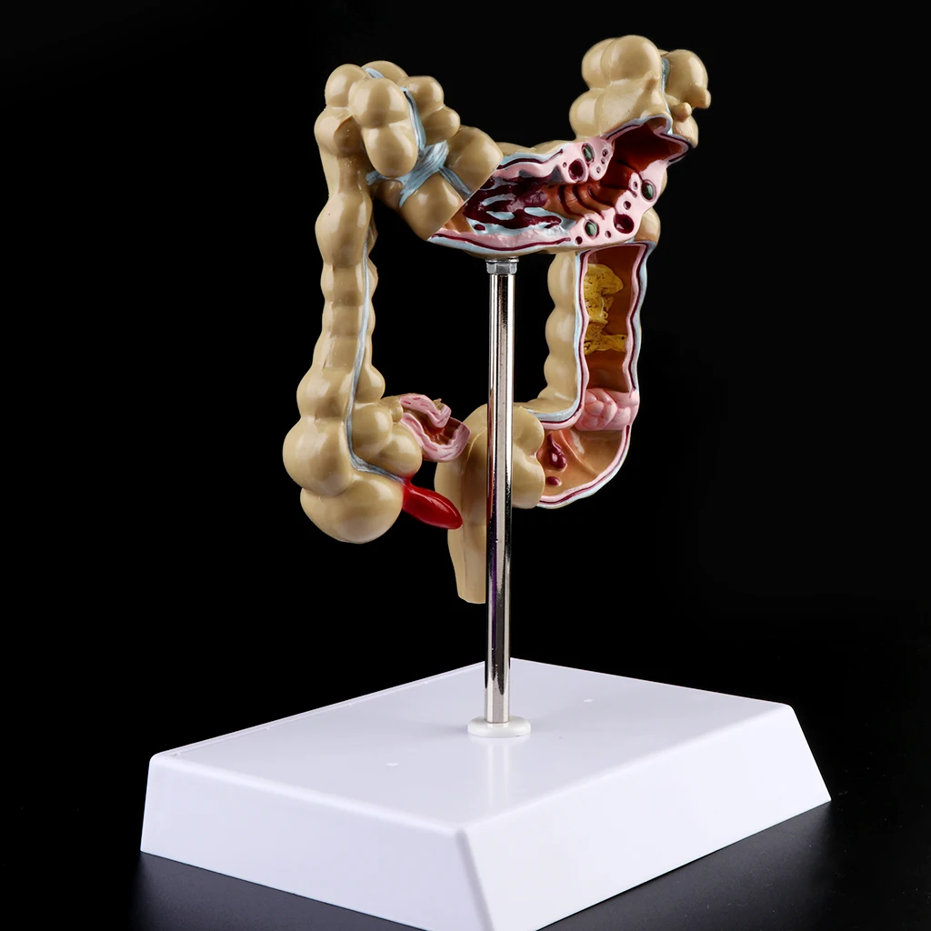 

Human Colorectal Lesion Model Pathological Anatomy Colon Diseases Intestine Medical Teaching Learning Tool