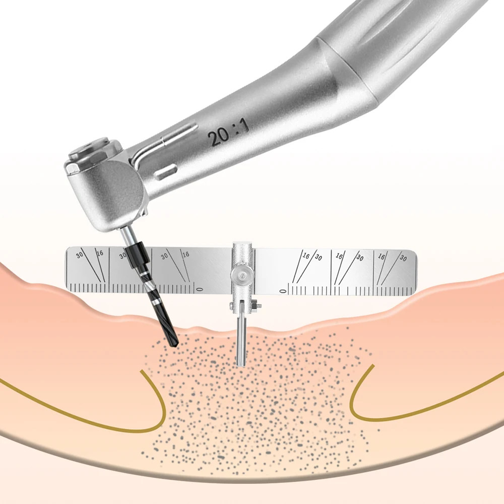 Dental Implant Locating Guide Surgical Planting Positioning Locator Angle Ruler Guage Autoclavable |