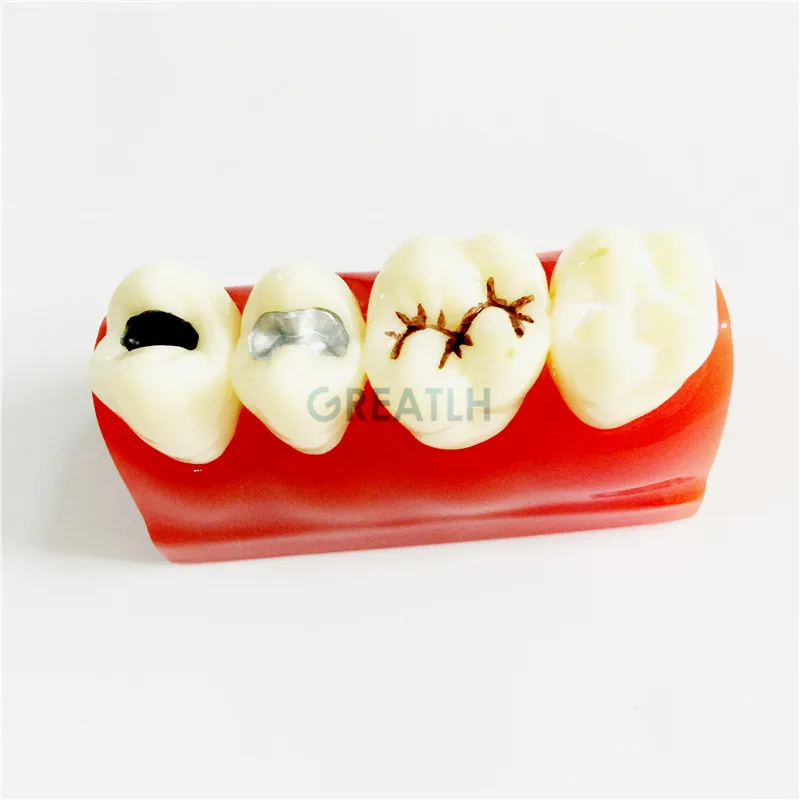 Модель для обучения стоматологии и уплотнению трещин зубов|tooth teeth|dental toothdental model