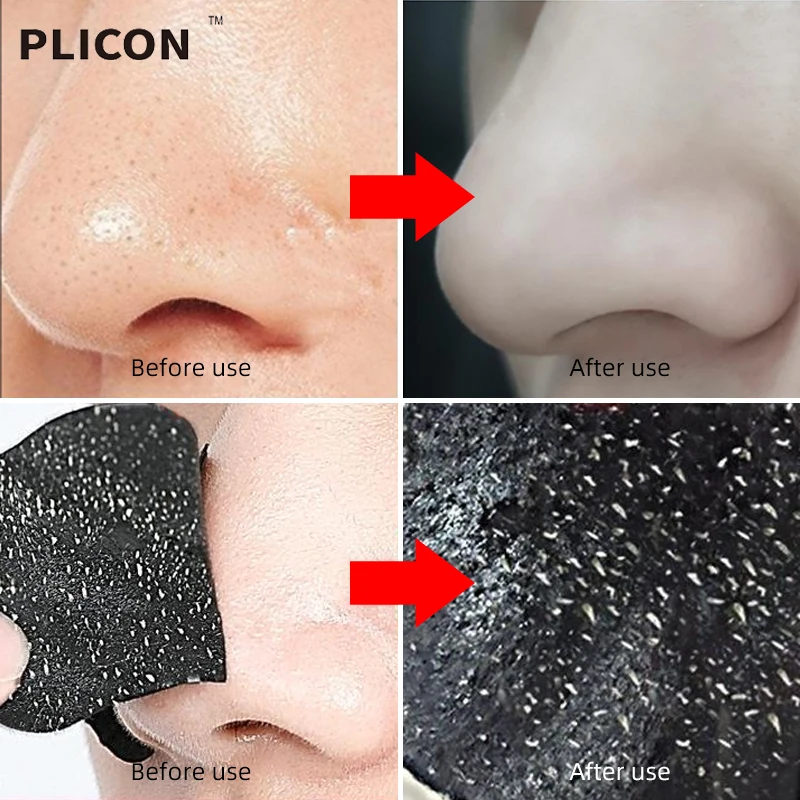 Черная маска для удаления черных точек лица и тела от гиалуроновая кислота