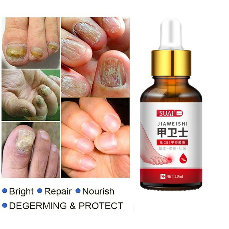 

Essential Oil Nail Fungus Treatment Foot Care Nail Anti-infective Paronychia Onychomycosis Whitening Toe Repair Gel