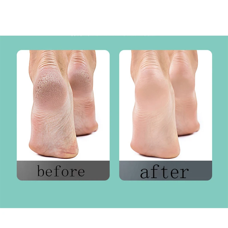 Электрическая мясорубка для ног 1 комплект устройство удаления омертвевшей кожи