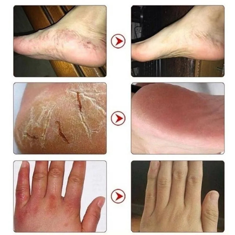 

15g/30g/50g Foot Chapped Repair Cream Foot Frostbite Cracking Cream Foot Care Anti-freeze Open Moisturizing Cream Anti-dryi J6Q6