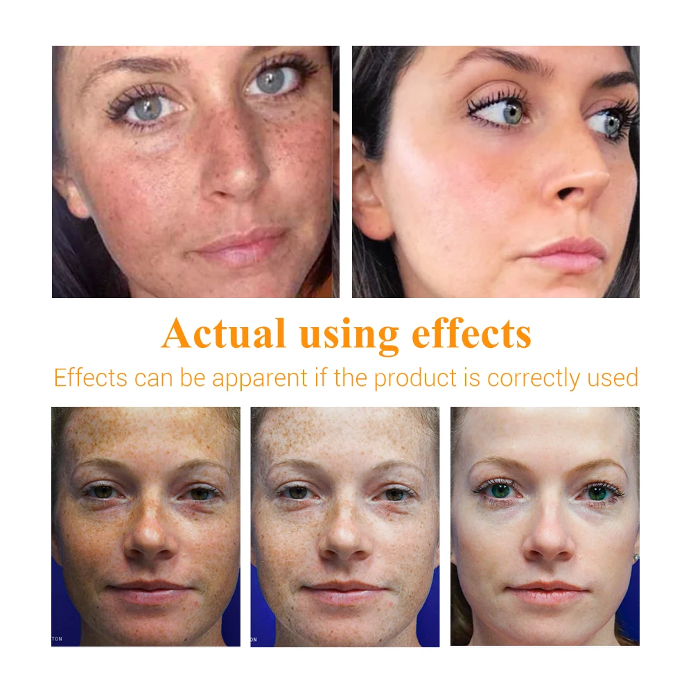

40ml vc remover dark spots skin care fade nourishing whitening serum essential oils facial essence