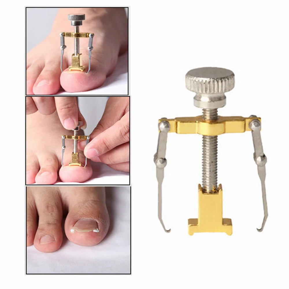 Ортопедический корректор для вросших ногтей из нержавеющей стали | Красота и