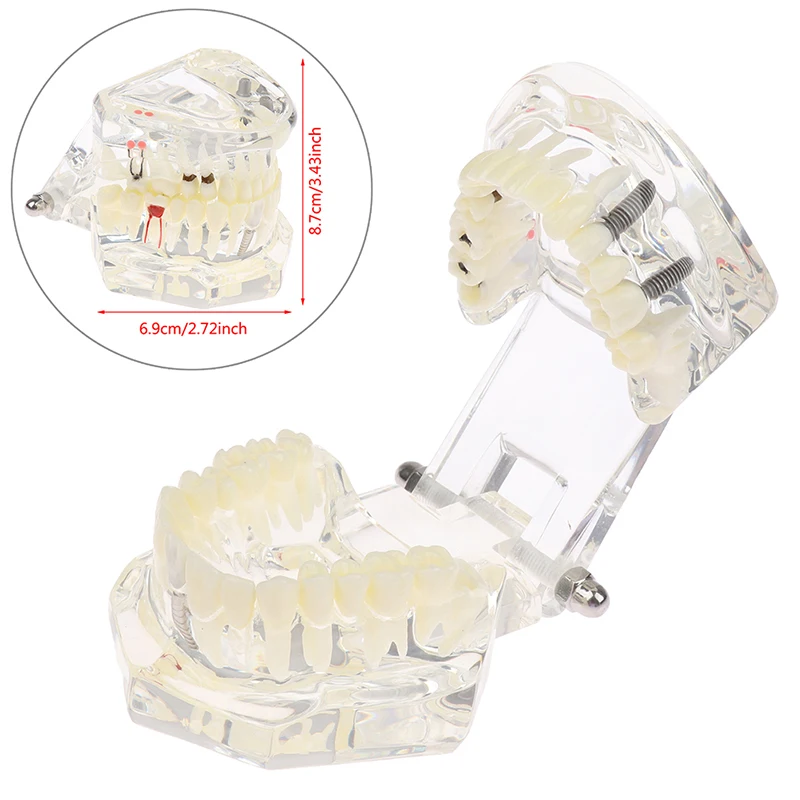 

Dental Model Teeth Implant Restoration Bridge Teaching for Study Tooth Science