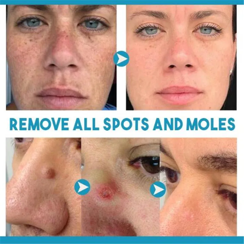 Skin Spots Removal Pen Mole Portable USB Charging Freckles Dark Spot Nevus Tattoo Dot Tag Remover Machine | Красота и здоровье