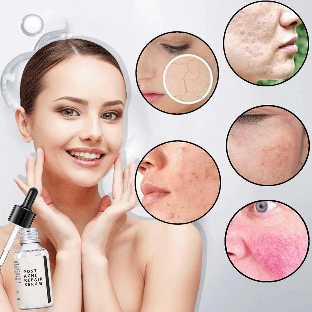 

15ml 30ml Whitening And Moisturizing Acne Shrink Pores Acne Scars Men Shrink Women Essence Moisturizing And Anti-Acne C7T2