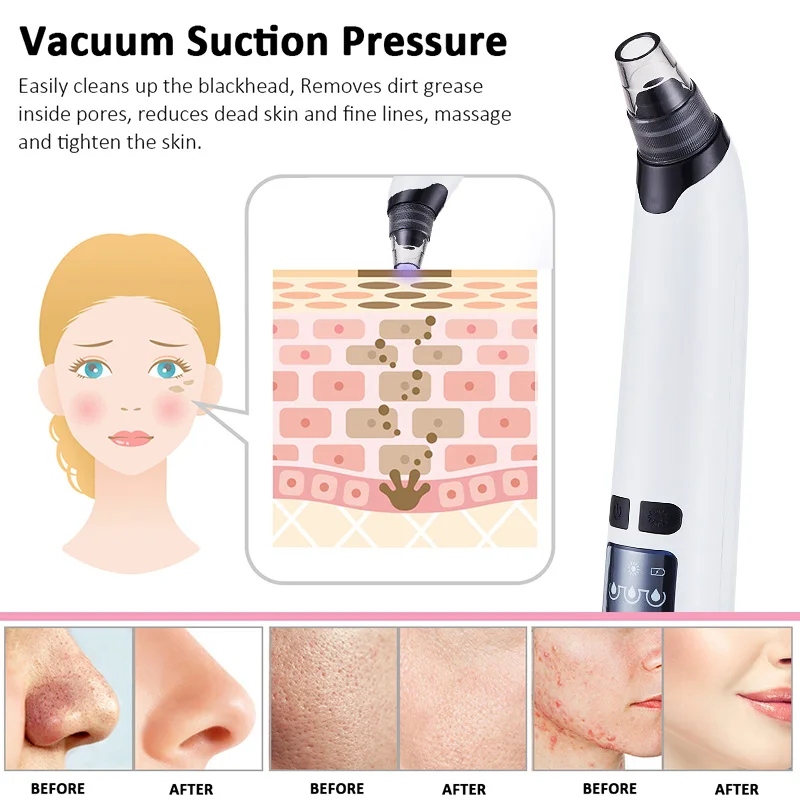 Средство для удаления черных точек вакуумный подогреватель очиститель пор